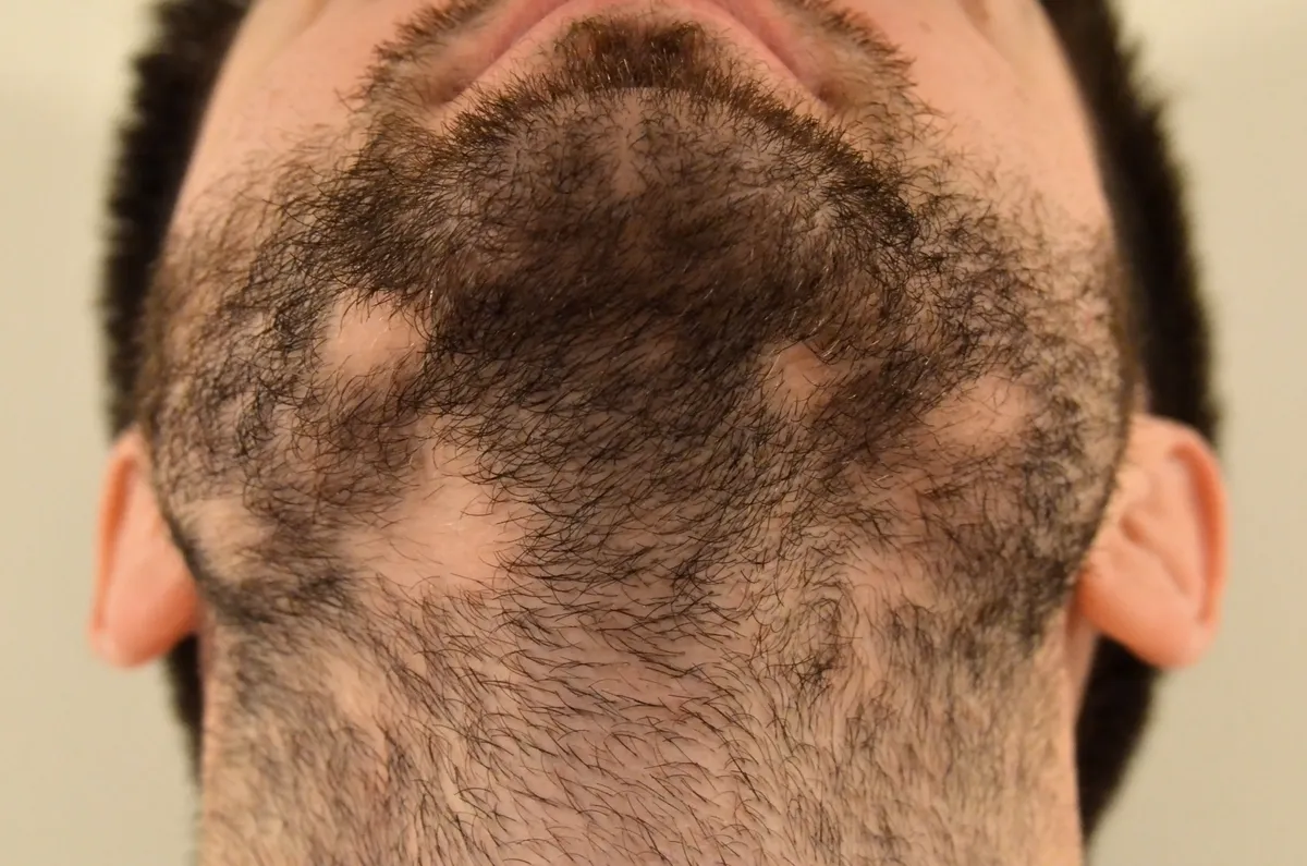 Łysienie plackowate – nierównomierne wypadanie włosów z brody